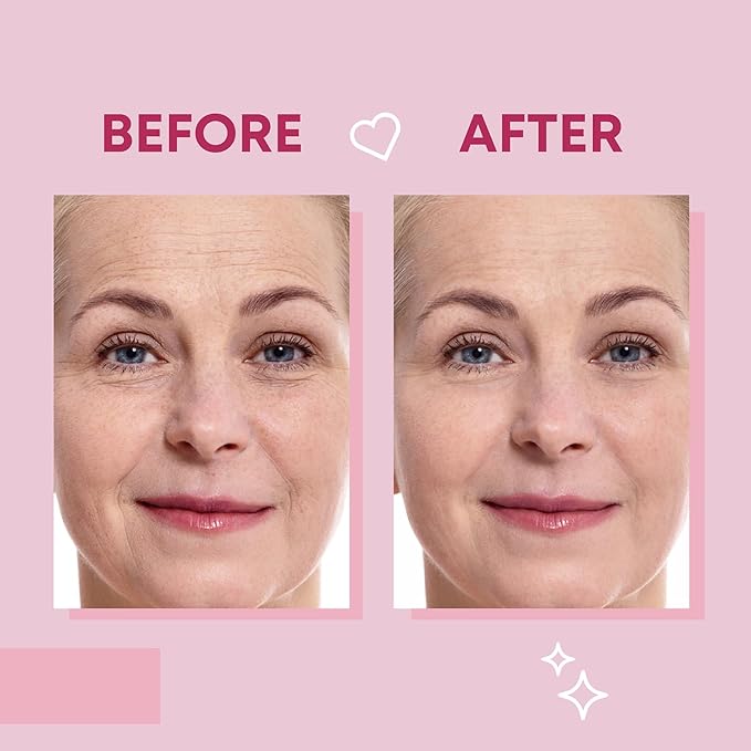 Forehead Wrinkle Patches and Smile Line Patches Set